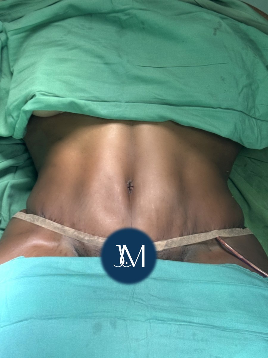 Abdominoplastia después