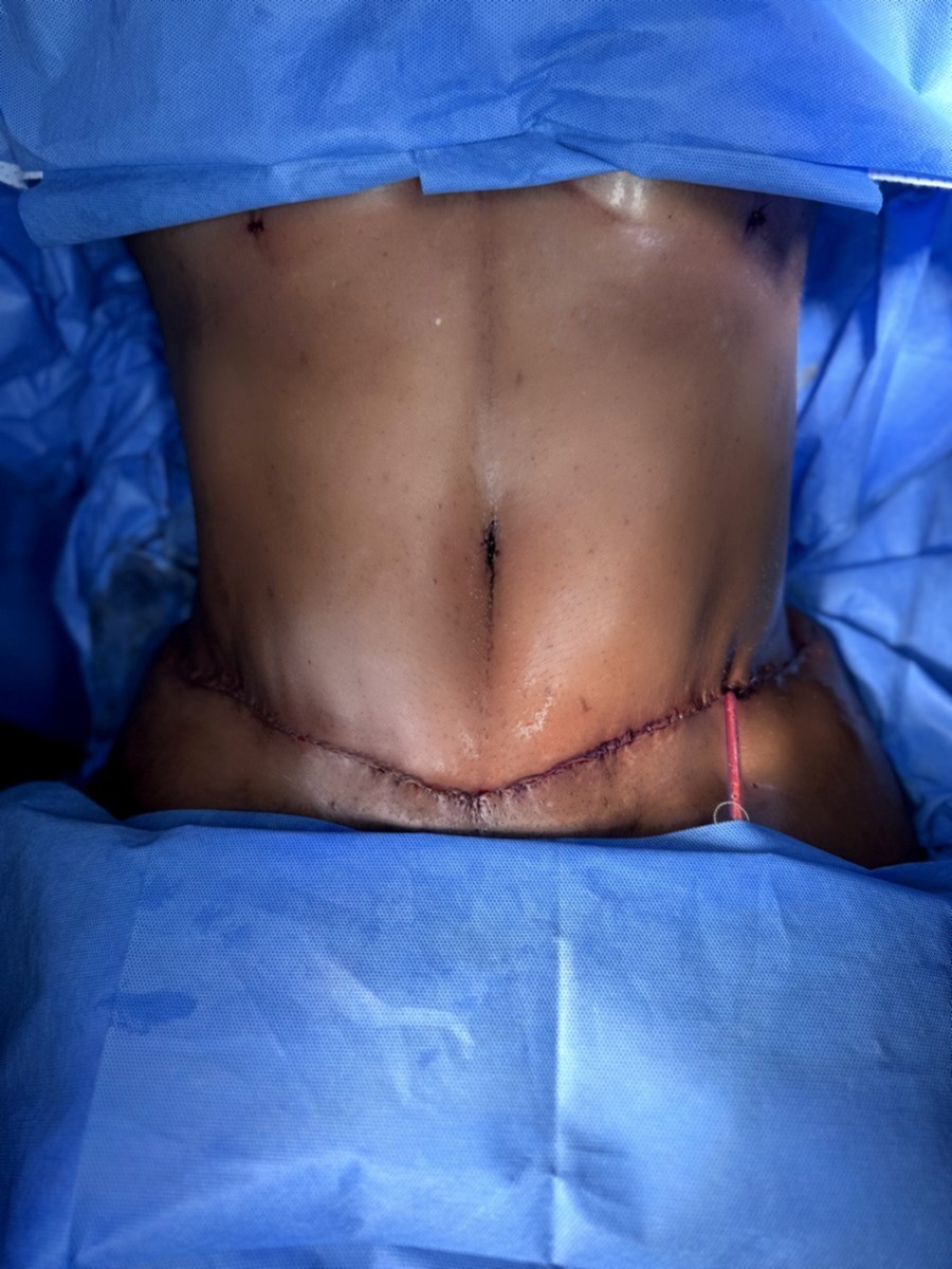 Abdominoplastia después